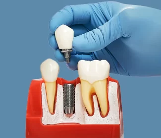 Why More Patients Are Choosing Dental Implants Over Other Options